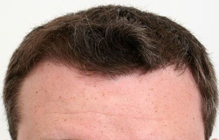 after hair restoration
