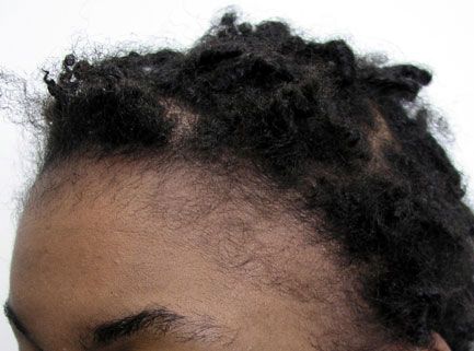 before hair restoration